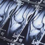 МРТ суглобів: точна діагностика травм, артриту та артрозу